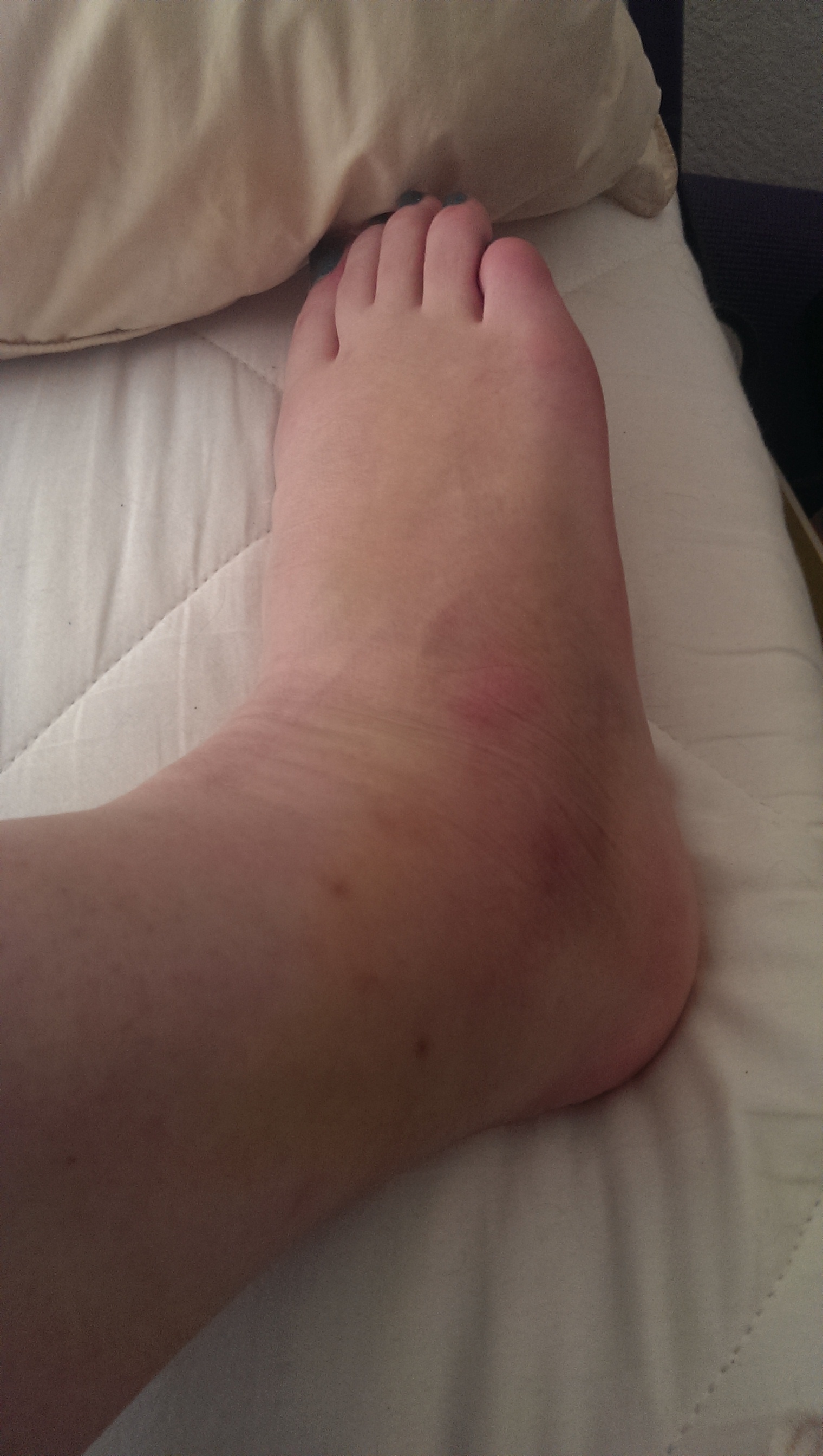 Cankle!