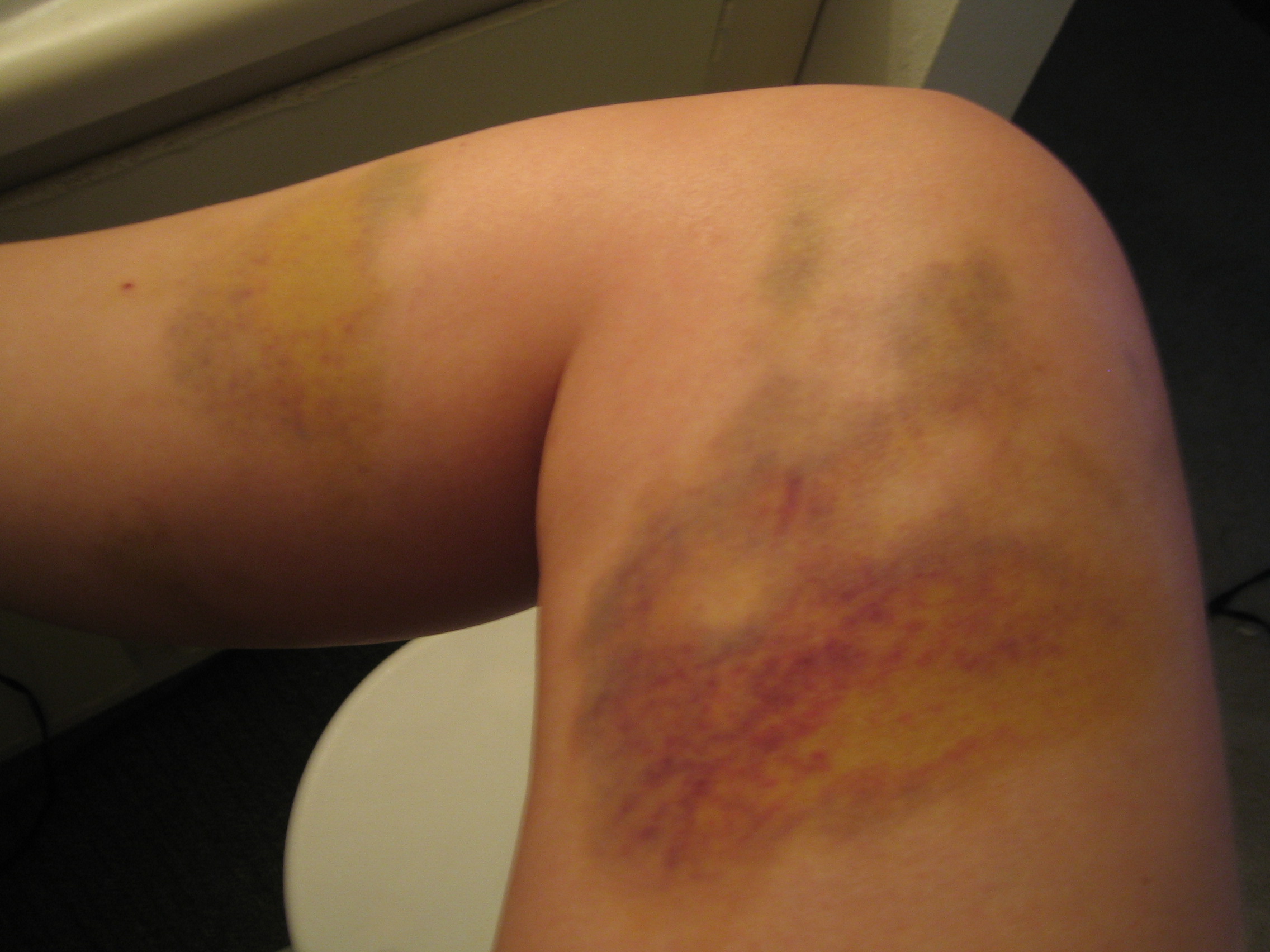 knee bruise